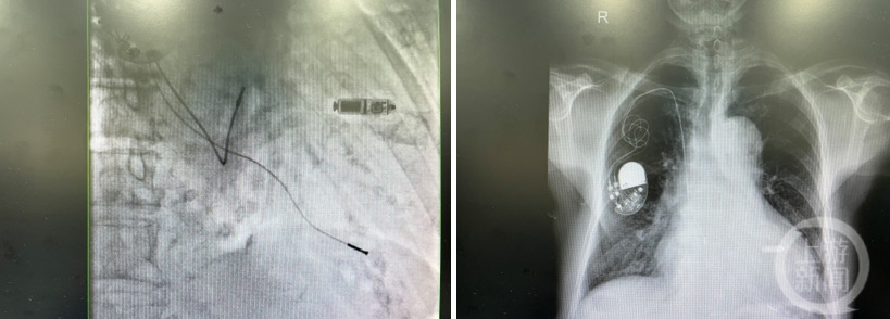 ▲仅2克重的起搏器已植入郭大爷的心腔内